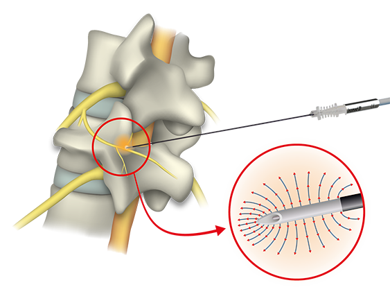 Illustration: RF electrode at target nerve of facet joint